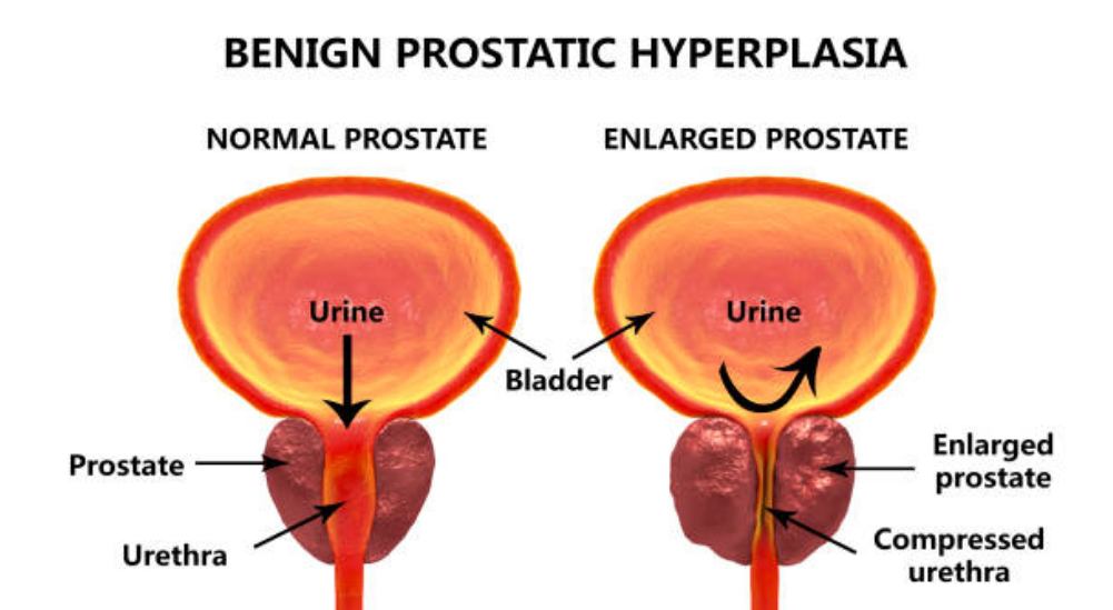 BPH benign prostate hypertrophy in ghaziabad